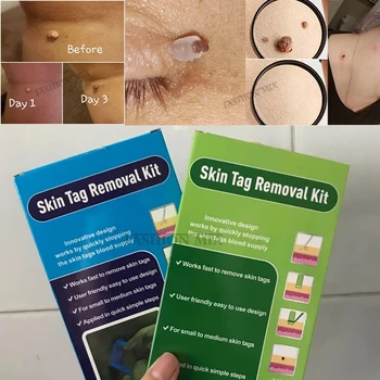 Δέρμα Αφαίρεσης Ετικεττών Εξάρτηση Θηλωμάτων Αφαίρεση Δερμάτων Καθαρίζοντας Εξάρτηση 4-6mm Tag Θεραπεία Για Αφαιρεί Berrugas Στο Δέρμα Κονδυλωμάτων Mole Remover